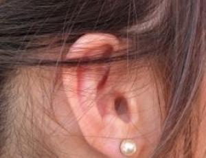 Women&amp;#039;s Hair Loss and PCOS