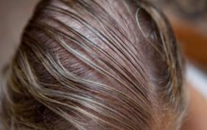 I&amp;#039;ve Finally Lost the Weight, But Now I am Losing My Hair